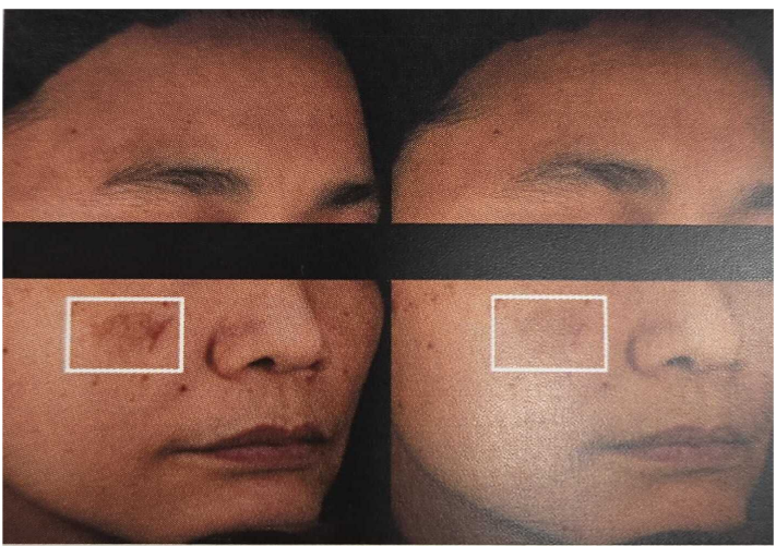 Before-and-after facial images showing observed changes in skin pigmentation after 60 days of Belight 300 mg intake